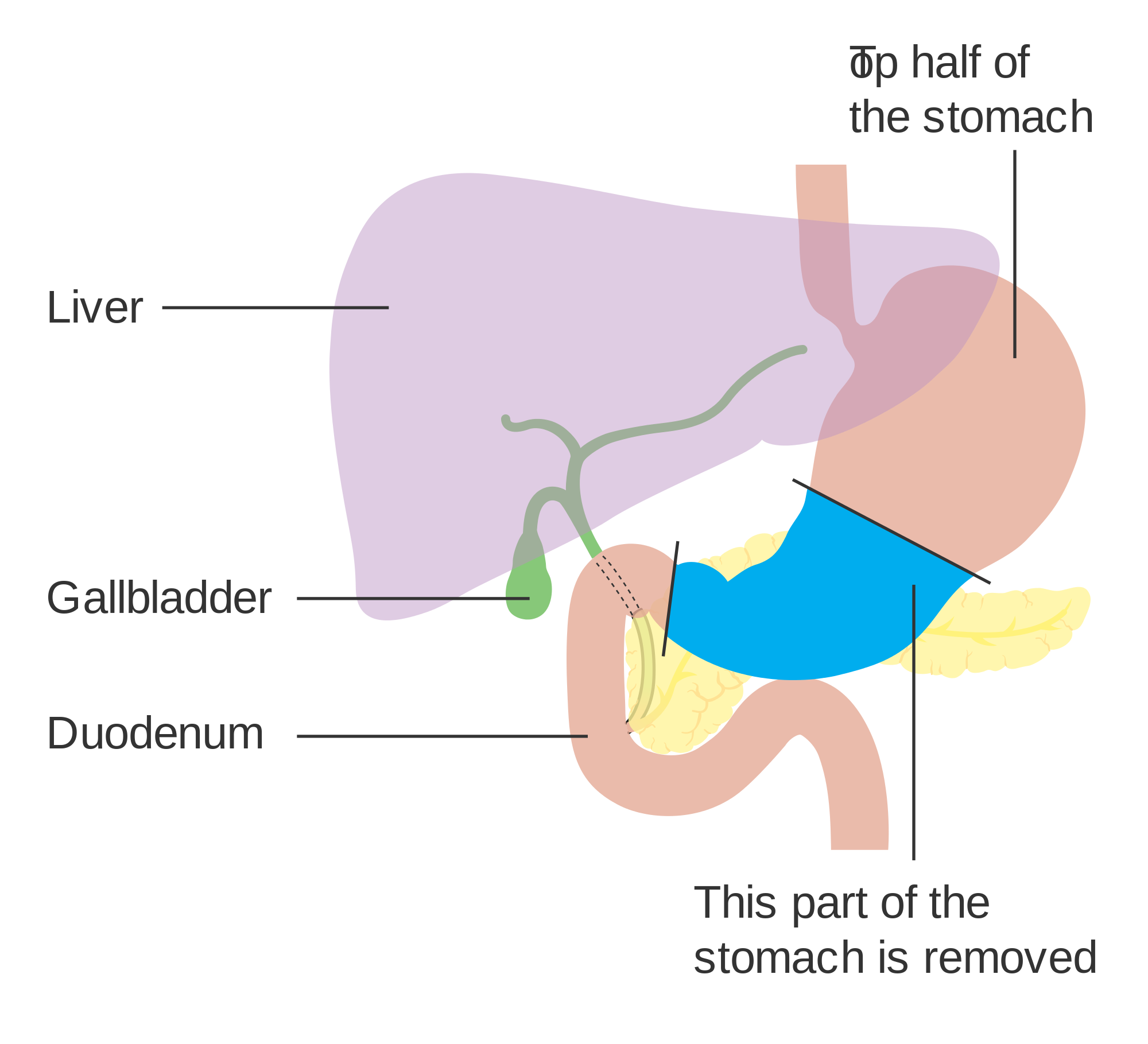 File:Diagram showing the part of the stomach removed for a Bilroth ...
