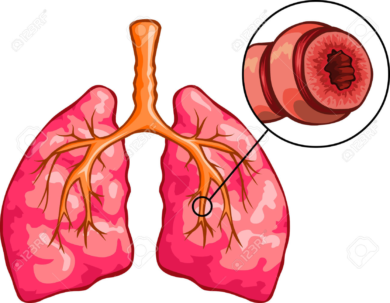 Бронхиальная астма легкие