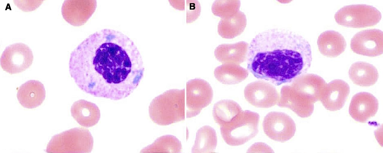 Pseudo–Pelger-HuÃ«t anomaly in a patient on tacrolimus | Blood Journal