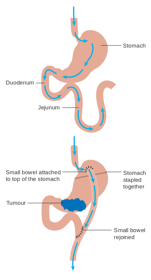 File:Diagram showing before and after stomach bypass surgery CRUK ...