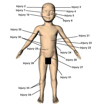 News - A body map showing Keanu Williams' injuries | Free Radio