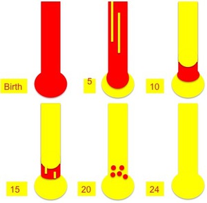 ECR 2009 / C-622 / Bone marrow of the non-traumatic knee: Expected ...