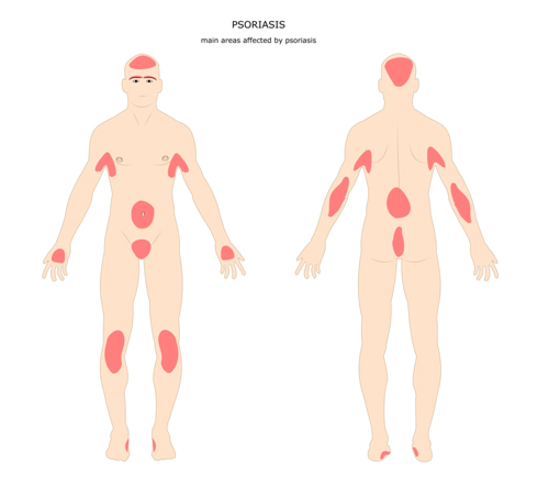 Psoriasis Causes and Symptoms