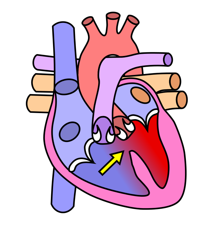 File:Heart vsd.svg