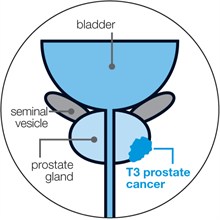 Locally advanced prostate cancer | Prostate Cancer UK