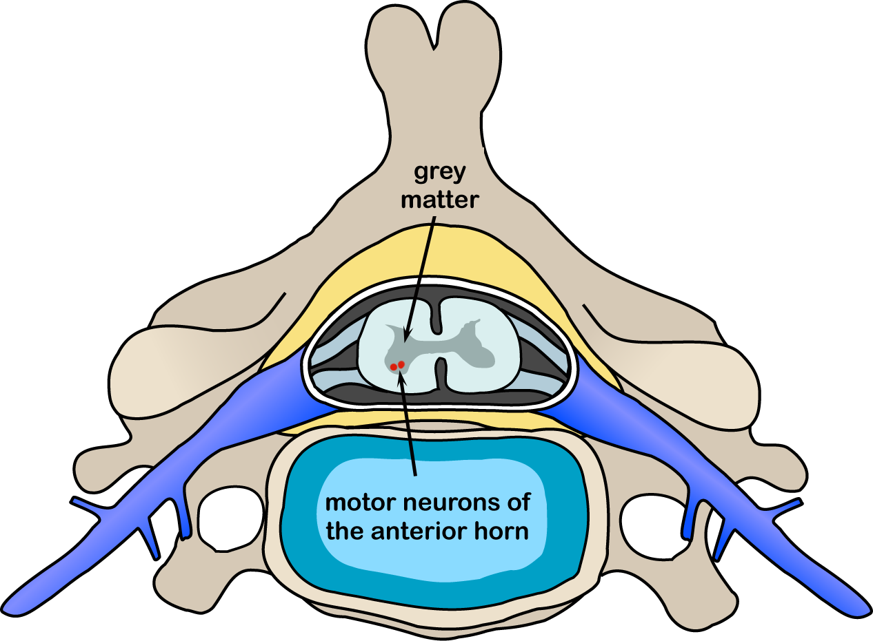 Spinal muscular atrophy