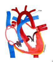 Patent Ductus Arteriosus (