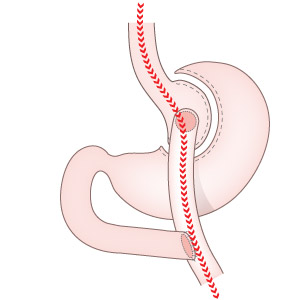 Gastric Sleeve Operation | The Hospital Group UK :: Weight loss ...