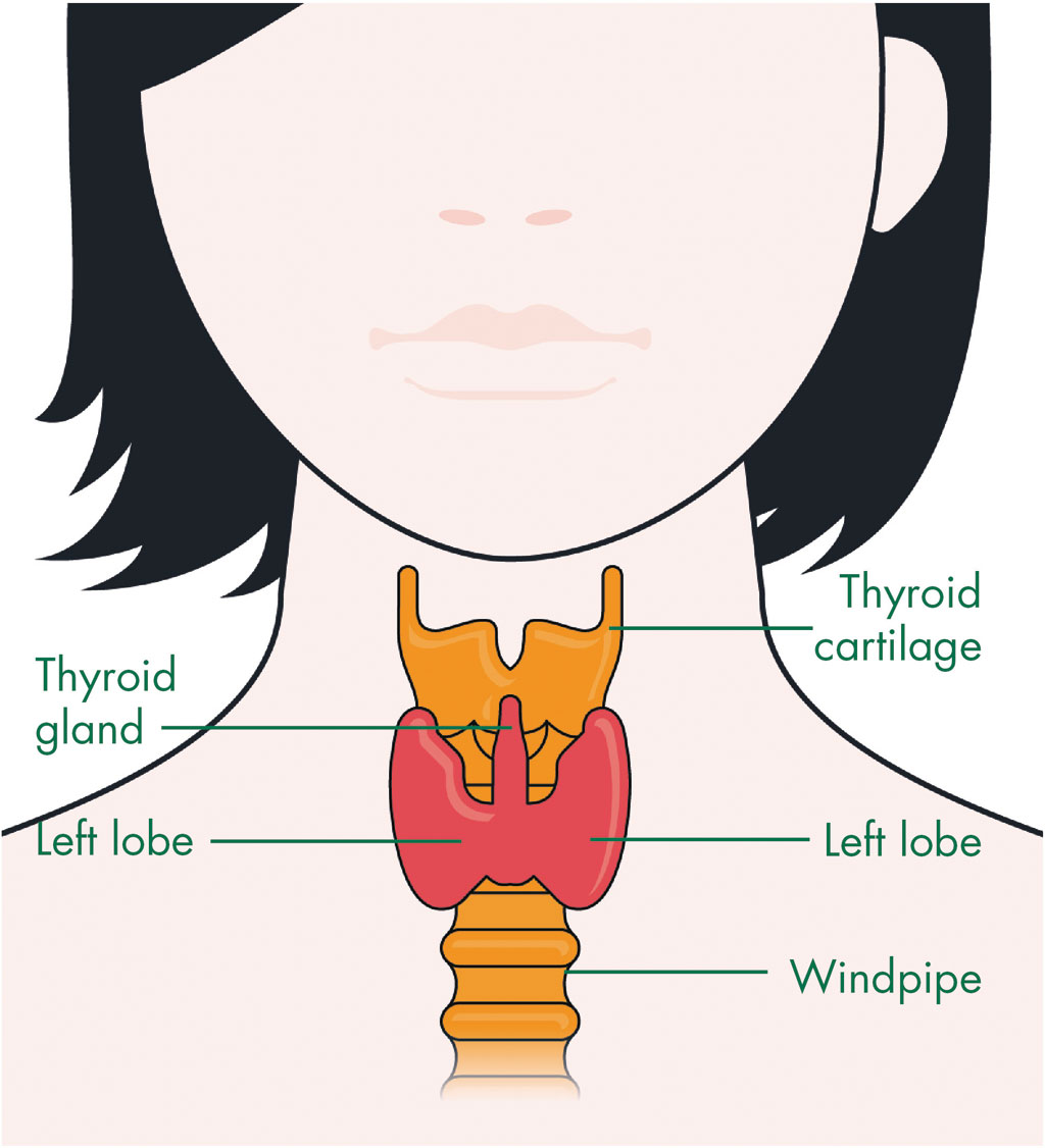 Thyroid lymphoma - Cancer Information - Macmillan Cancer Support