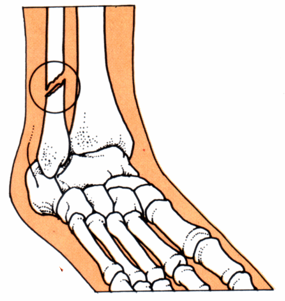 Broken Leg Clipart