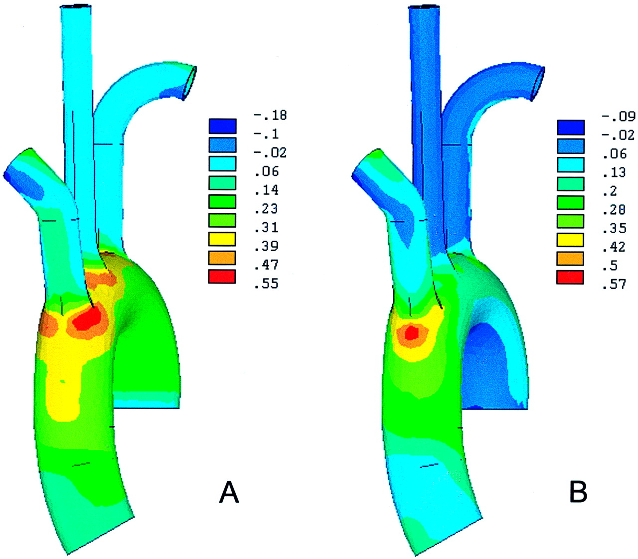 Role of Aortic Root Motion in the Pathogenesis of Aortic ...