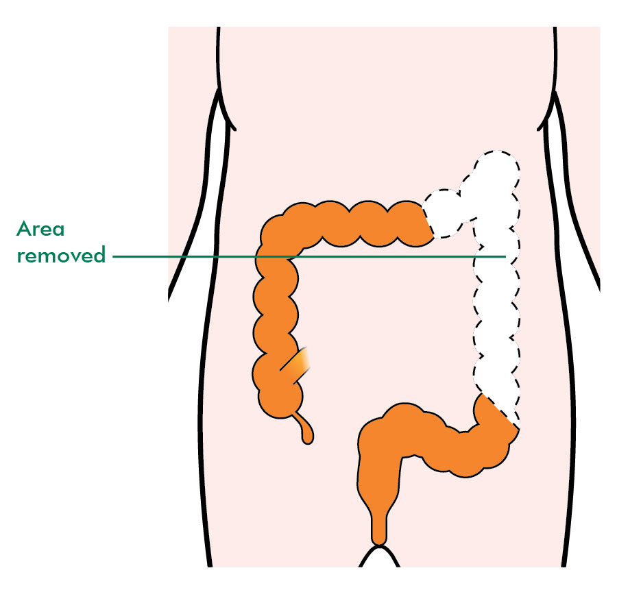 Types of surgery for colon cancer - Information and support ...