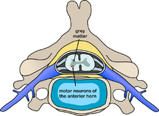 Spinal muscular atrophy: Definition from Answers.