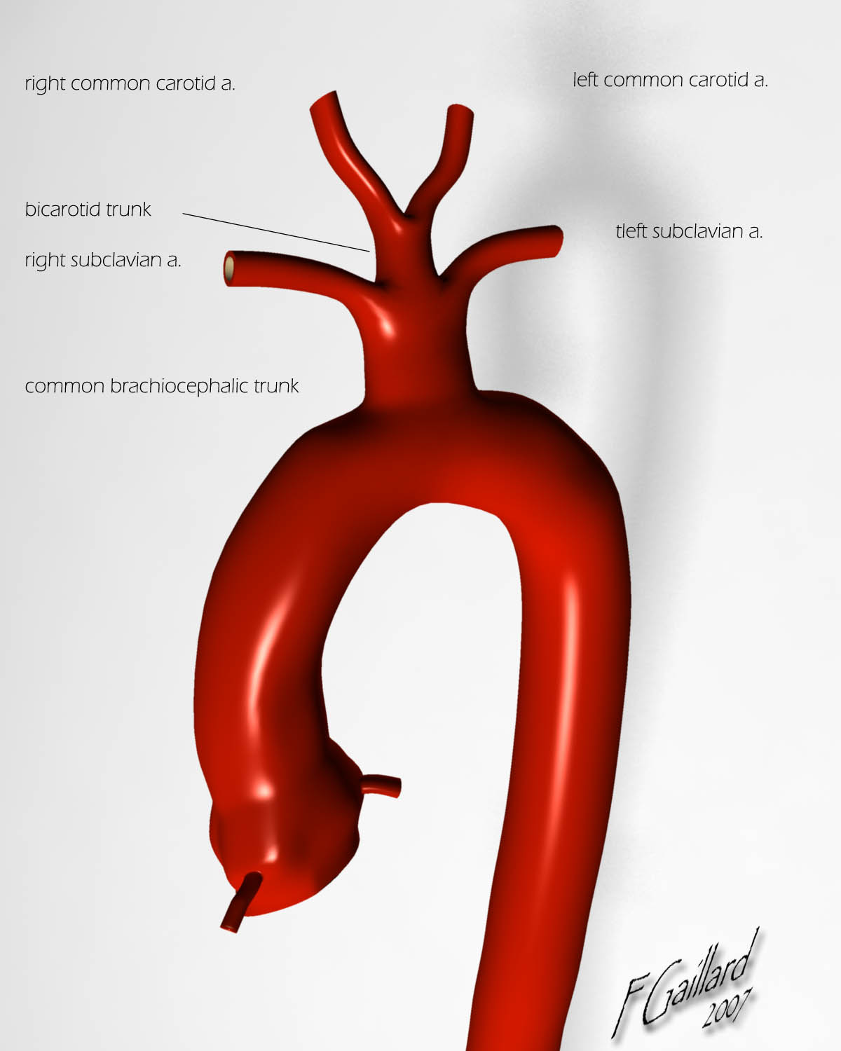 Bovine arch | Radiology Reference Article | Radiopaedia.