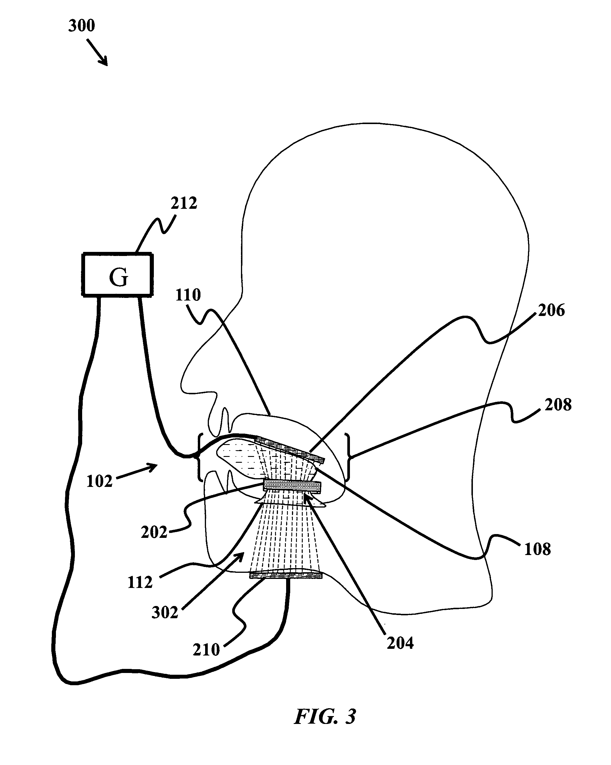 Patent US20090149849 - Device and method to treat tissue with ...