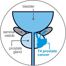 Locally advanced prostate cancer | Prostate Cancer UK - ClipArt Best ...